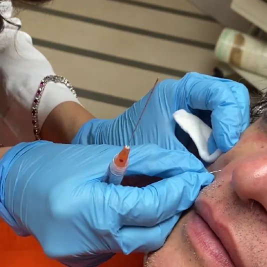 biostimolazione
