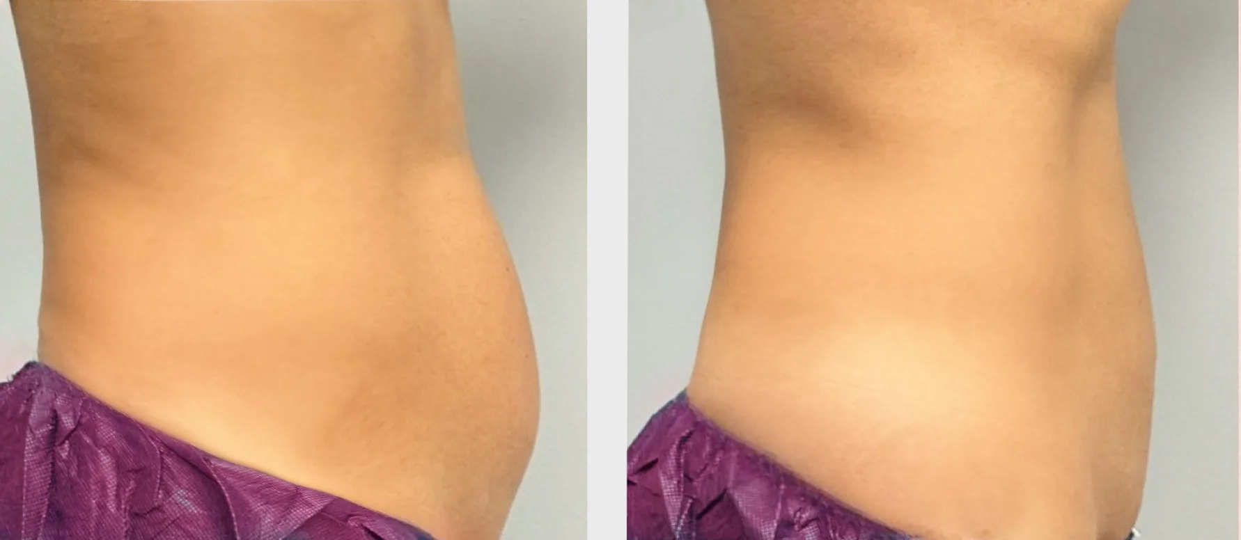 bodysculpting_prima_e_dopo