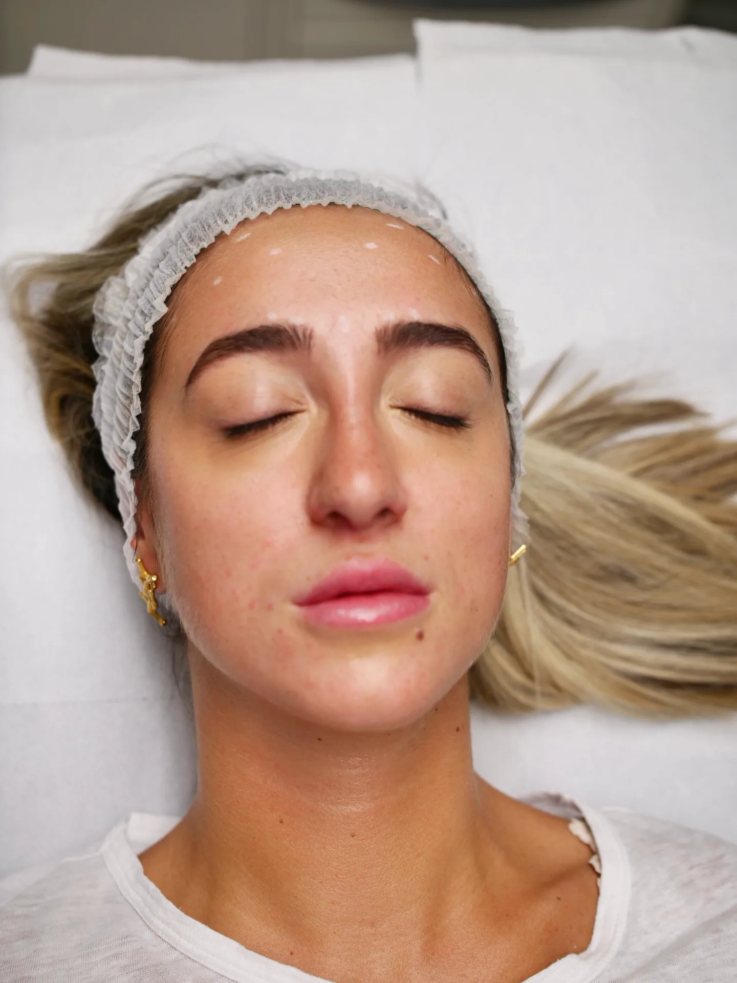 botox
