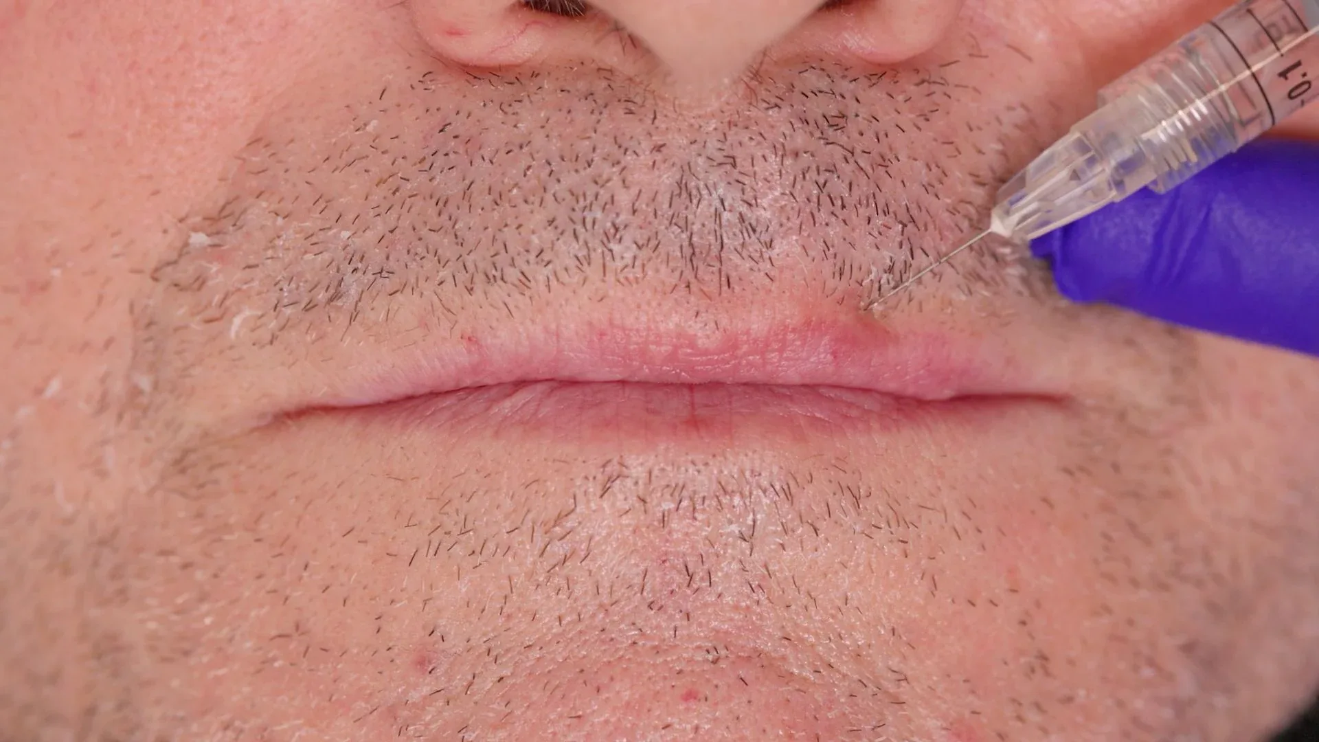 filler