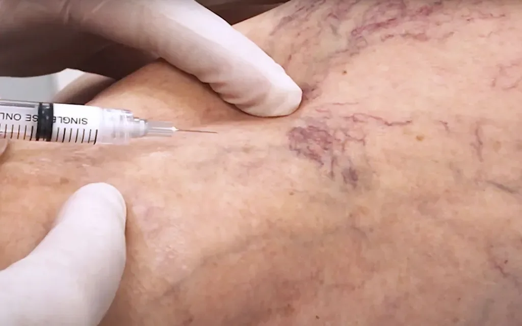 terapia_sclerosante
