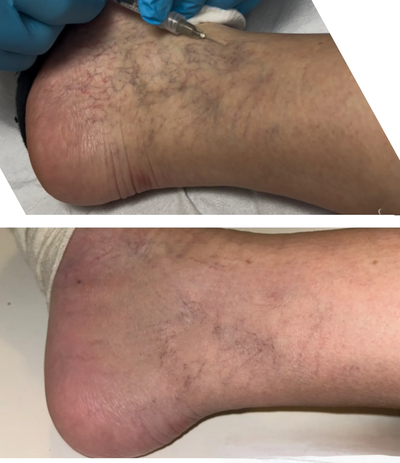 terapia_sclerosante_prima_e_dopo