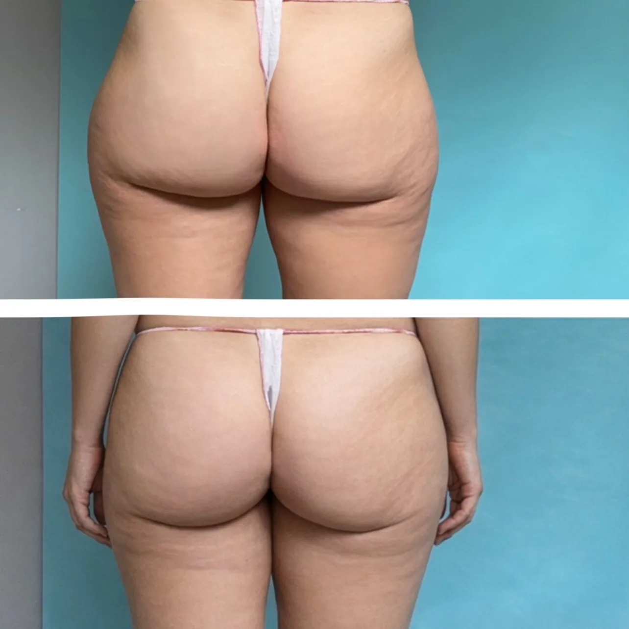 gluteofiller_prima_e_dopo