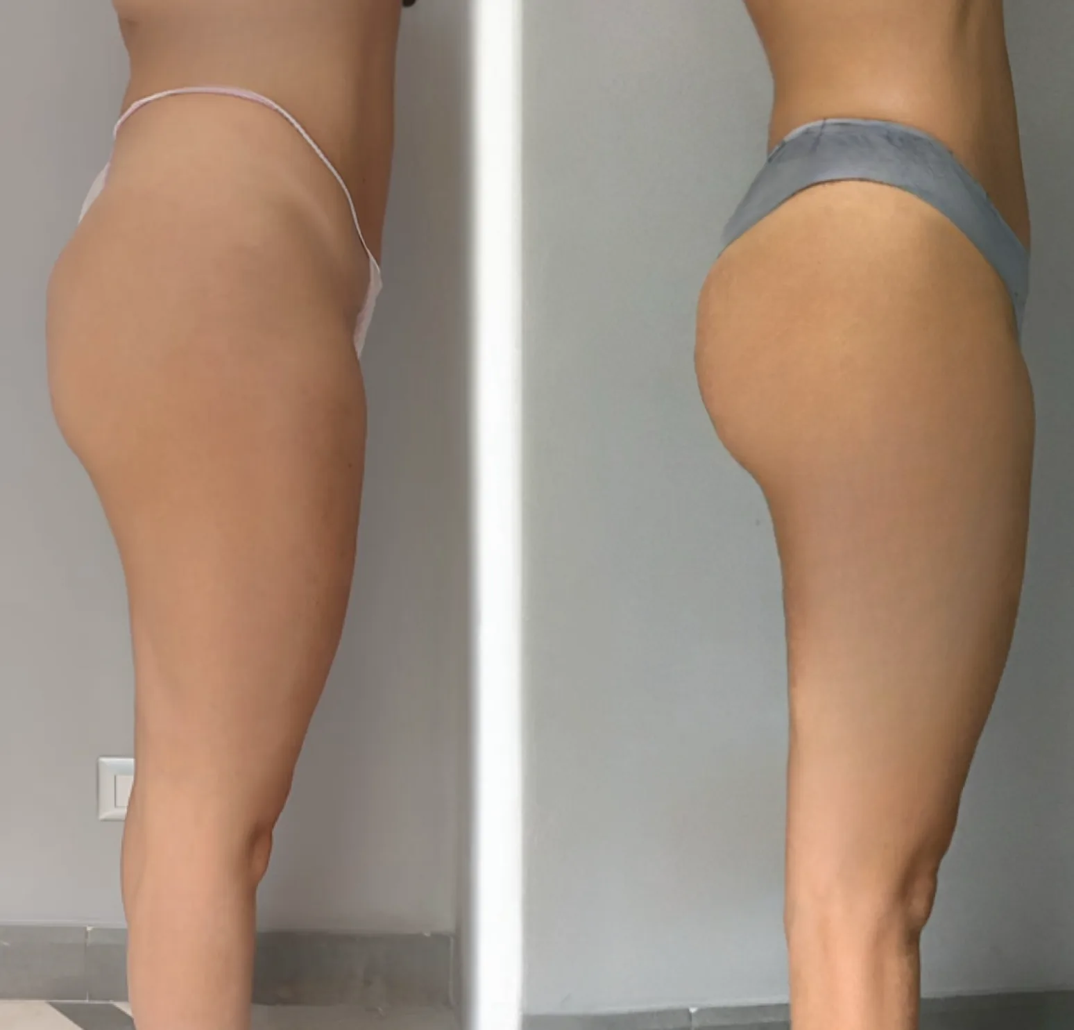 gluteofiller_prima_e_dopo_di_profilo