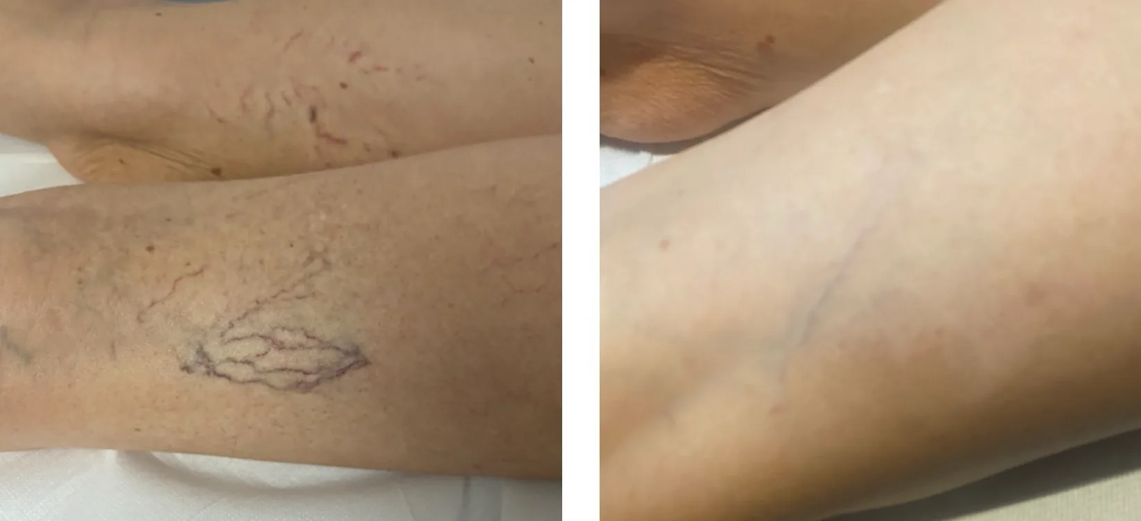 laser_vascolare_per_capillari_prima_e_dopo.jpg