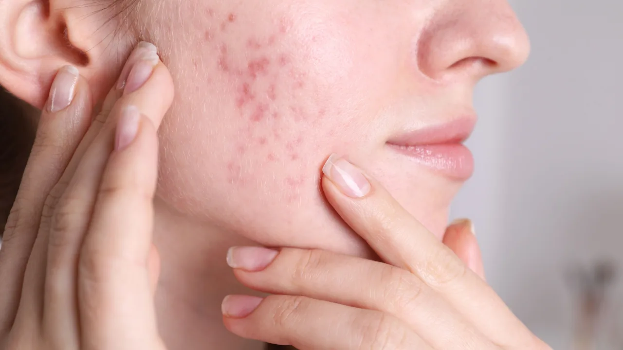trattamento_acne