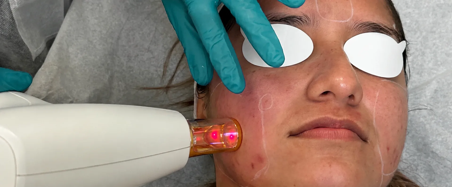 trattamento_rosacea